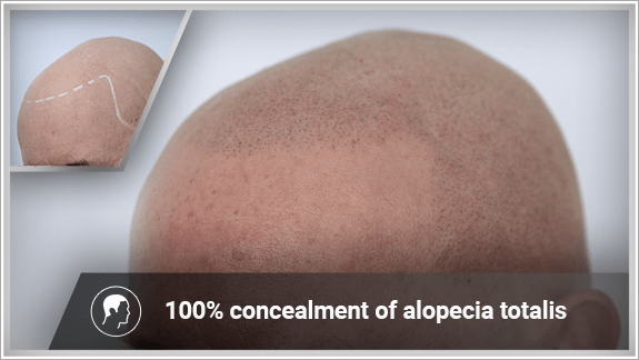 100% concealment of the alopeica totalis