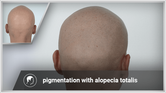 Solution for Alopecia Universalis