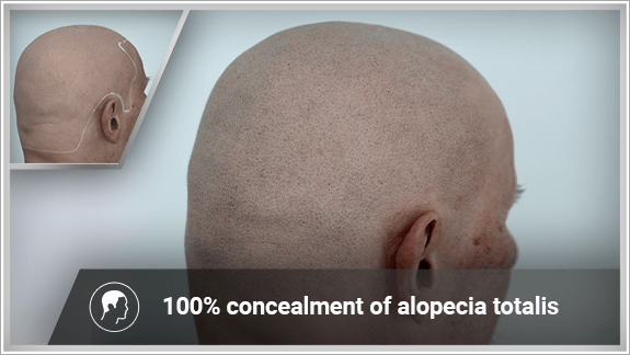 100% concealment of the alopeica totalis