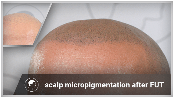 scalp micropigmentation after FUT