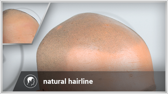 natural hairline