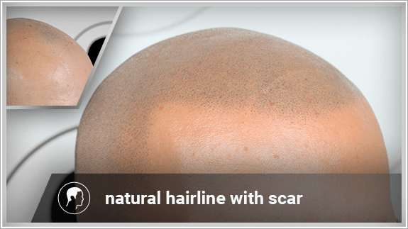 natural hairline with scar