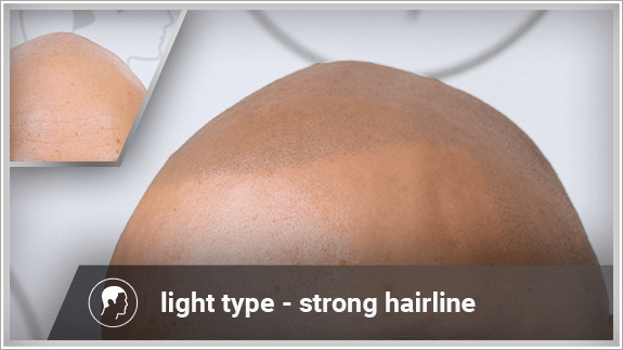 light type - strong hairline