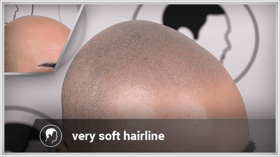 very soft hairline
