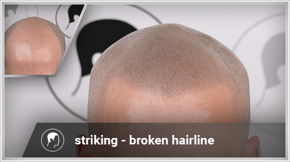 striking - broken hairline