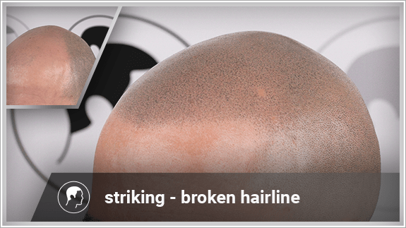 striking - broken hairline