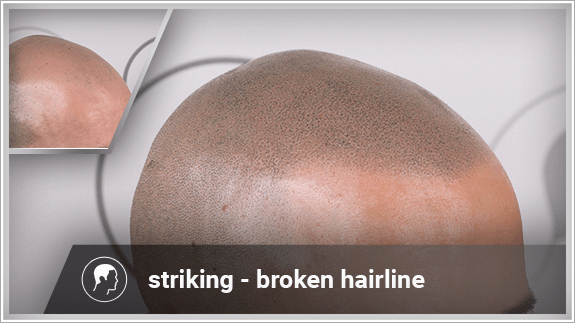 striking - broken hairline