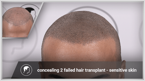 concealing 2 failed hair transplant - sensitive skin