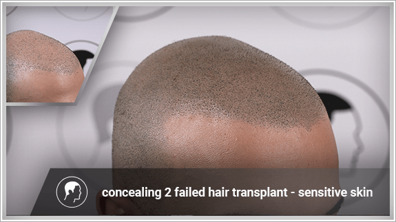concealing 2 failed hair transplant - sensitive skin