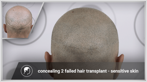 concealing 2 failed hair transplant - sensitive skin