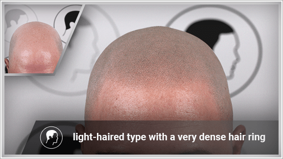 light-haired type with a very dense hair ring