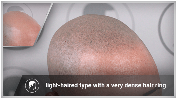 light-haired type with a very dense hair ring