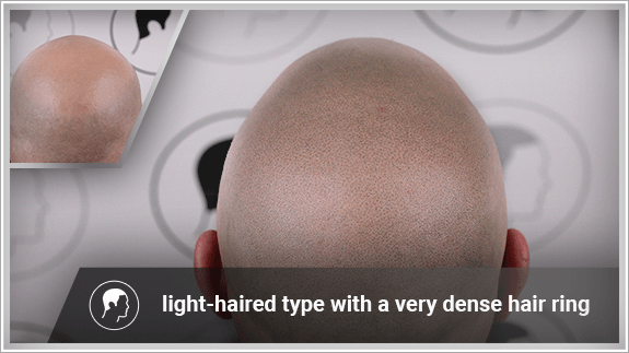 light-haired type with a very dense hair ring
