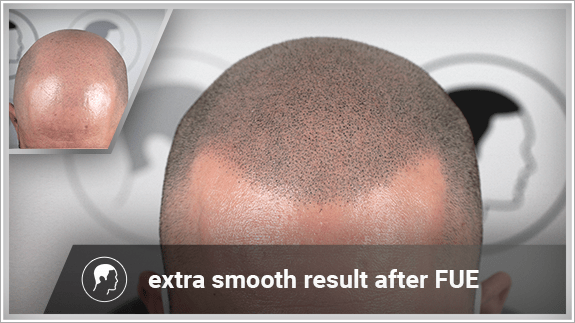extra smooth result after FUE
