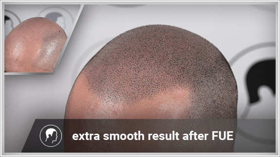 extra smooth result after FUE