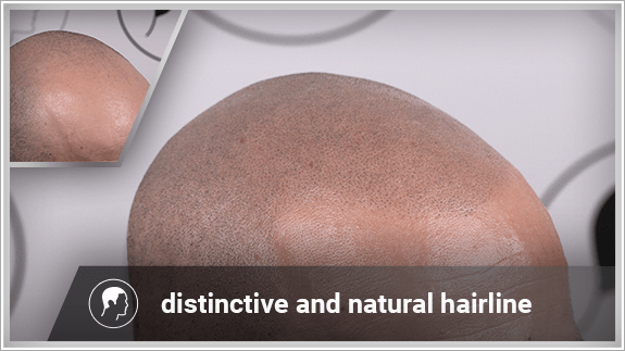 distinctive and natural hairline