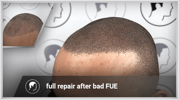 full repair after bad FUE