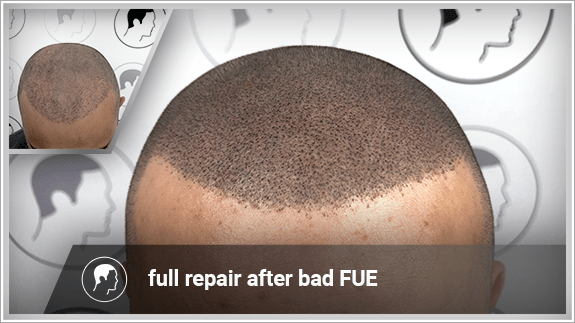 full repair after bad FUE