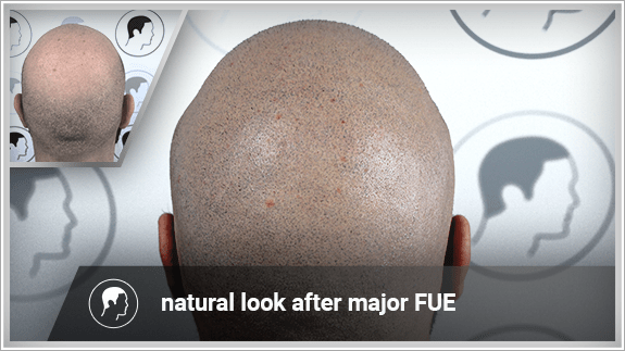 natural look after major FUE
