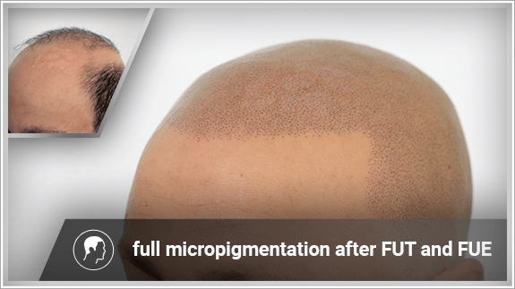 full micropigmentation after FUT and FUE
