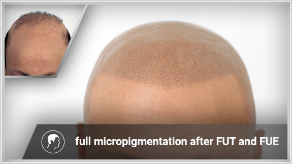 full micropigmentation after FUT and FUE