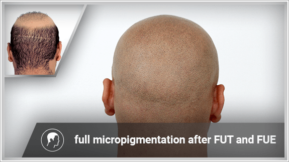 full micropigmentation after FUT and FUE