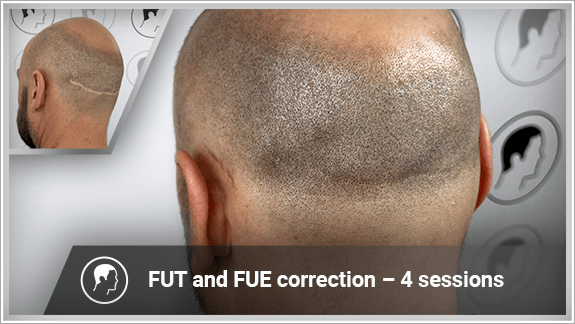FUT and FUE correction – 4 sessions