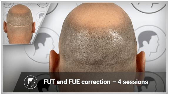 FUT and FUE correction – 4 sessions