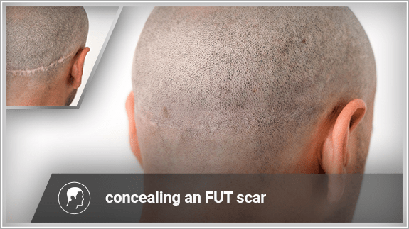 concealing an FUT scar
