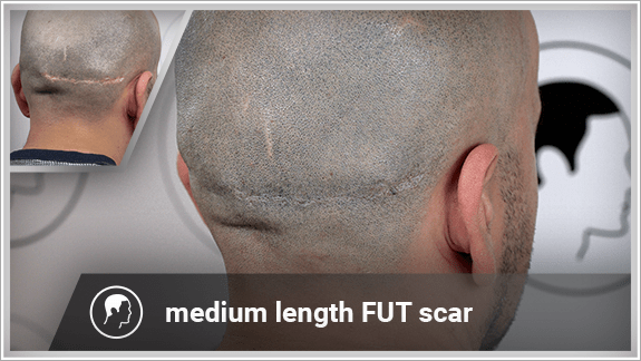 concealing an medium length FUT scar