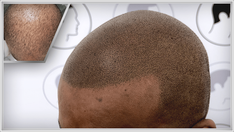 A man with a small amount of remaining hair regains full hair density thanks to scalp micropigmentation
