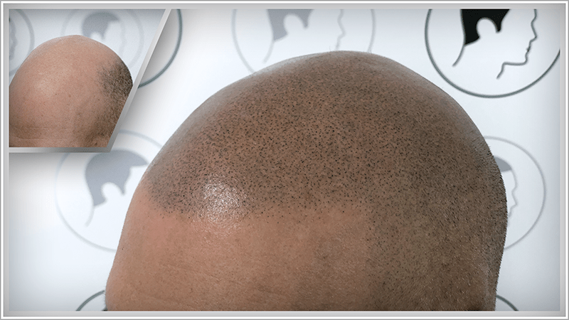 An older man with greyish hair no longer has a visible bald patch