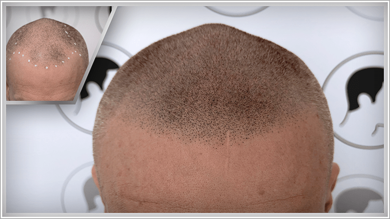 A man with moderate hair loss regains his natural hairline and hair density