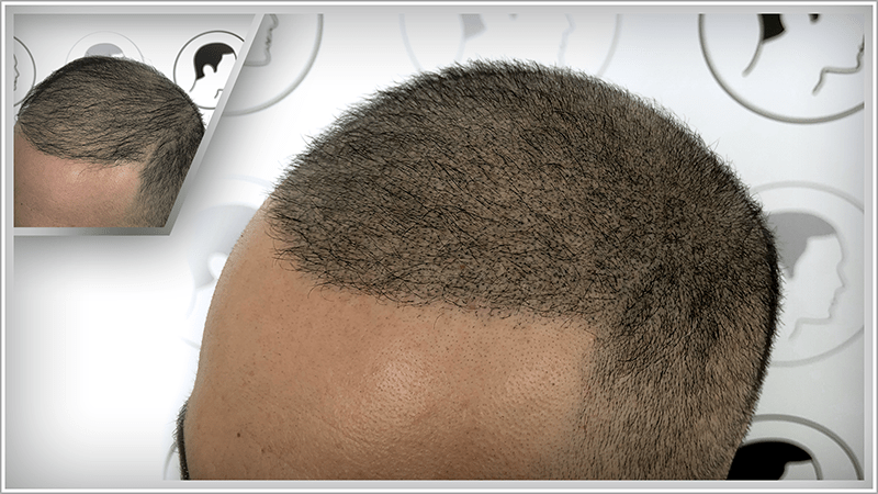 A man with a bad hair transplant gets his hair thickened with scalp micropigmentation