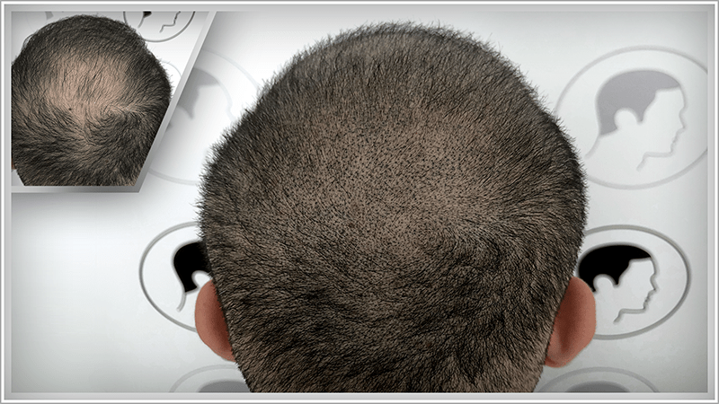 The tonsure needs to be thickened with scalp micropigmentation, despite a hair transplant