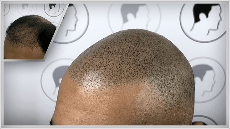A man opts for scalp micropigmentation following a bad hair transplant