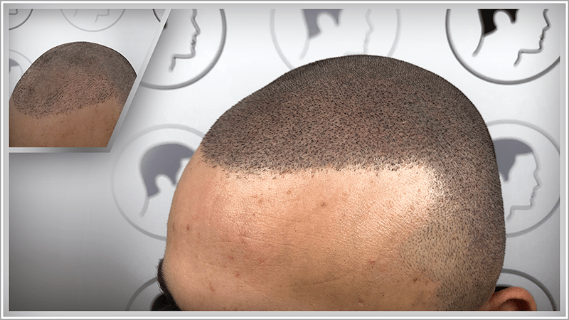 A very unnatural-looking hair transplant is concealed using scalp micropigmentation