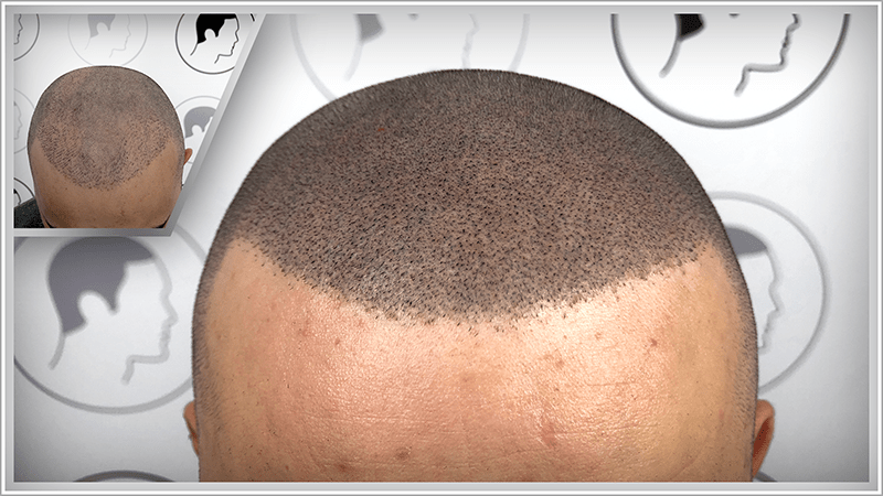 Scalp micropigmentation renders a bad hair transplant invisible