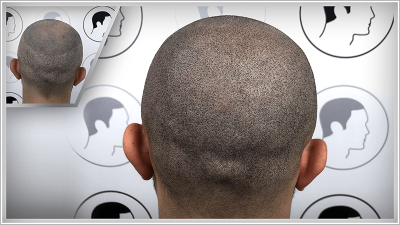 The scars in the donor area are also concealed by scalp micropigmentation