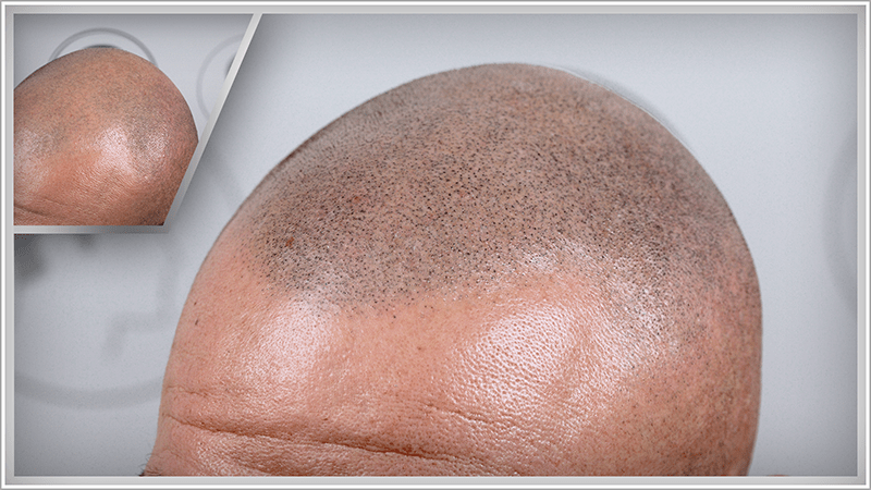 An older man with grey hair has his bald patch completely concealed using scalp micropigmentation
