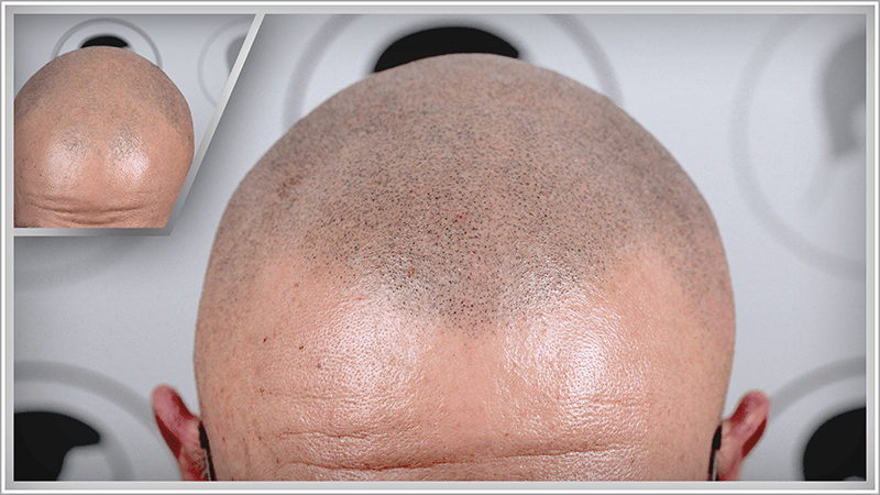 Scalp micropigmentation on a completely bald head makes an older man with grey hair look younger