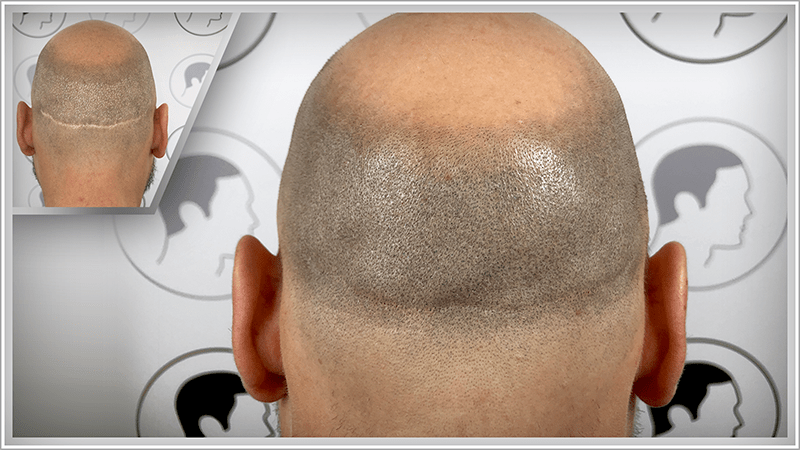 Unsightly scars and strip scars concealed at last thanks to scalp micropigmentation