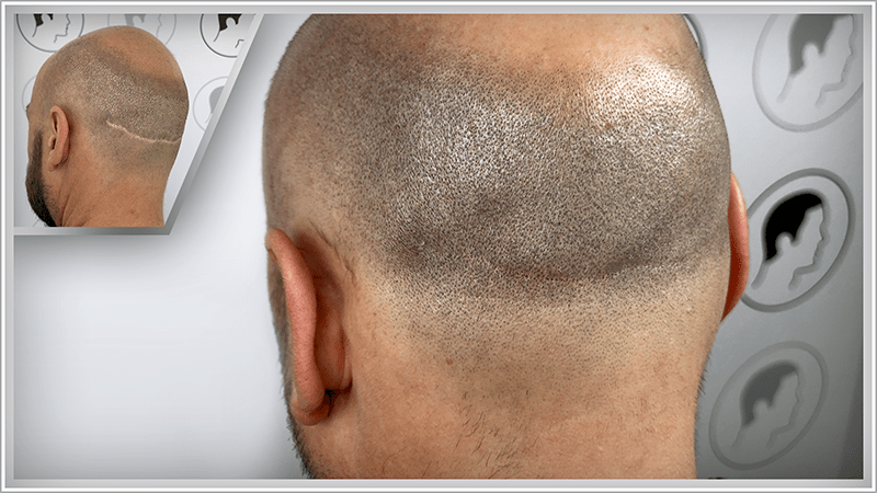 Ugly FUT and FUE scars are completely covered thanks to scalp micropigmentation