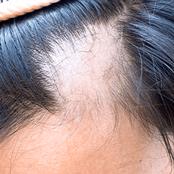 Norwood 2 status are medium receding hairlines.