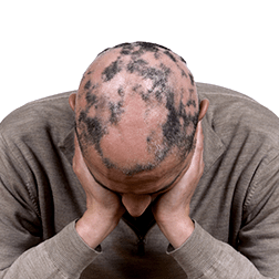 Scalp micropigmentation can help especially alopecia areata.