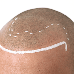 Hairline design for the correction of hair pigmentation.