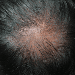 Alopecia universalis: Complete hair loss all over the body