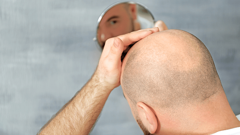 Bald man looks at himself in the mirror