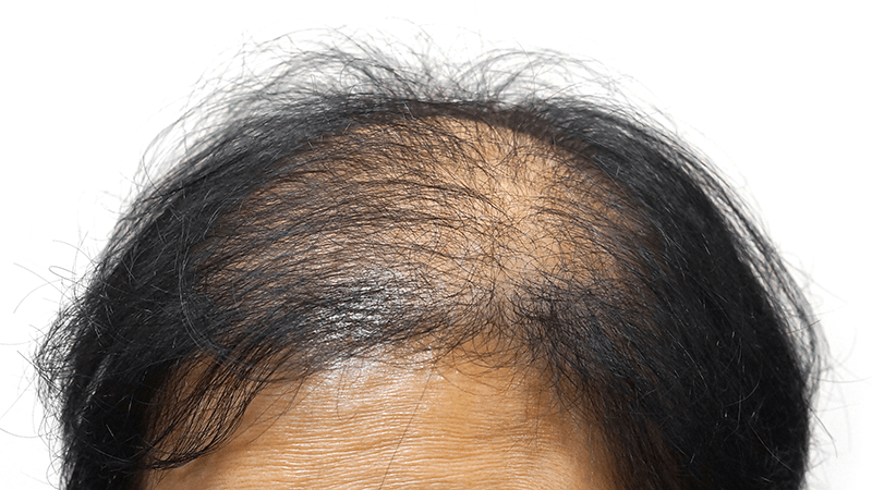 Woman with severe genetic hair loss