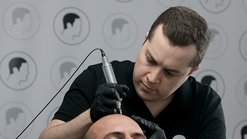 Our scalp micropigmentation practitioner George conceals advanced hair loss
